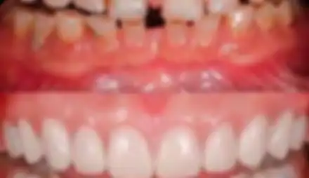 Diseño de sonrisas #2