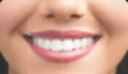 Diseño de sonrisas #3