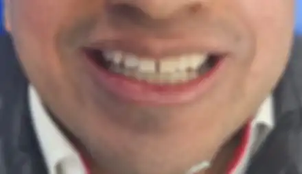 Diseño de sonrisas #1
