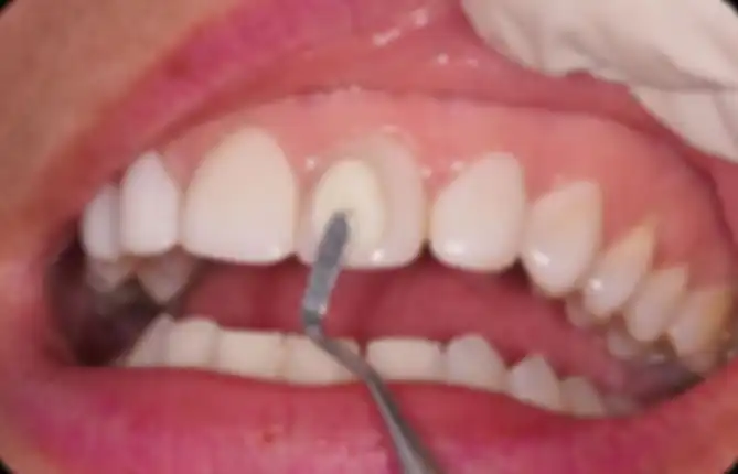 Diseño de sonrisas
