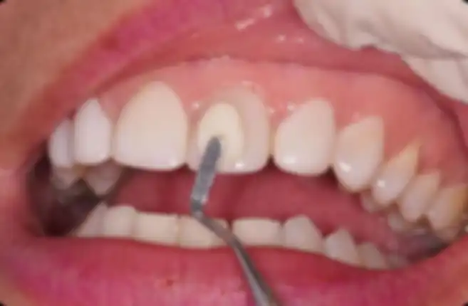 Diseño de sonrisas