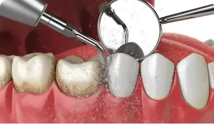 Importancia de la limpiezan dental profunda en tu salud bucal